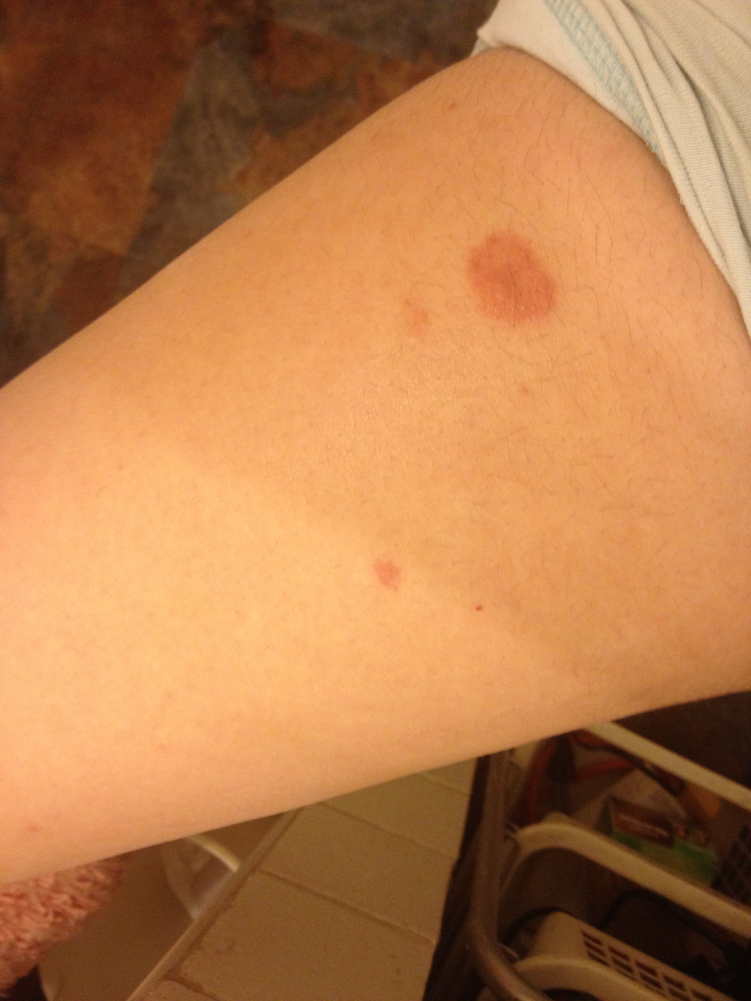 Pityriasis Rosea - American Family Physician